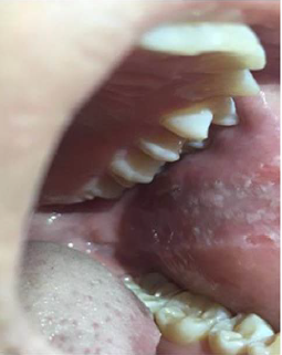 Múltiples lesiones traumáticas asociadas al hábito de mordisqueo