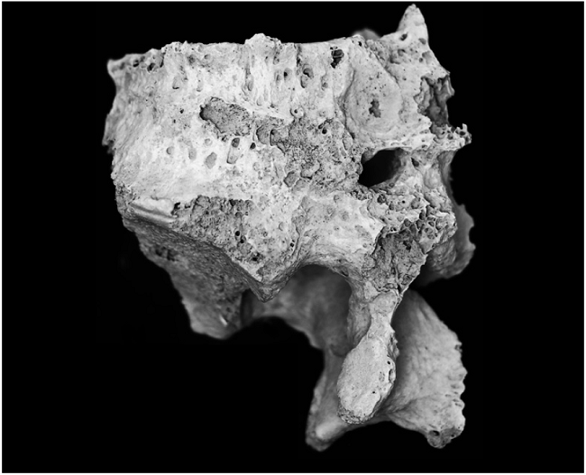 V&eacute;rtebras lumbares fusionadas en una mujer mayor de 60 a&ntilde;os.