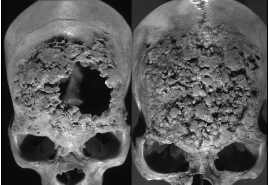 Caries sicca en dos cr�neos humanos recuperados de la Cueva de la Candelaria.