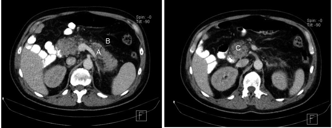 Figura 1. Tomograf&iacute;a axial computada de abdomen con contraste.
  Gl&aacute;ndula pancre&aacute;tica de densidad heterog&eacute;nea, tama&ntilde;o aumentado tanto en cuerpo (A) y cabeza (C) con leve despullimiento del tejido graso pancre&aacute;tico (B).
