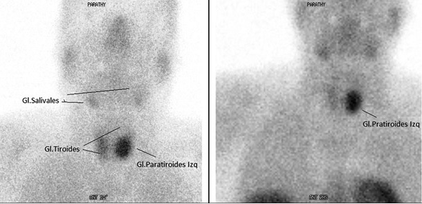 Figura 2. Centellograf&iacute;a de paratiroides.