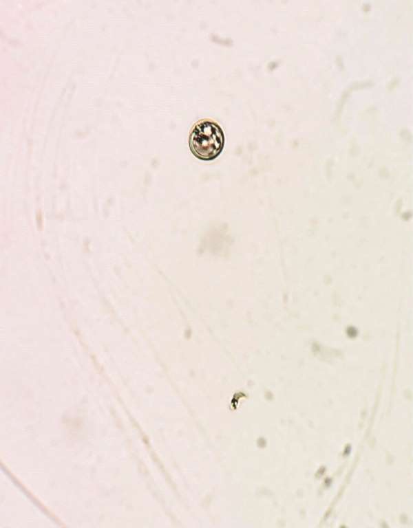 Microscopia en fresco (1.000x) del concentrado del LCR, entre porta y cubreobjeto, que revela en un mismo campo microscópico, un tripomastigote (abajo) y una levadura redonda (arriba).