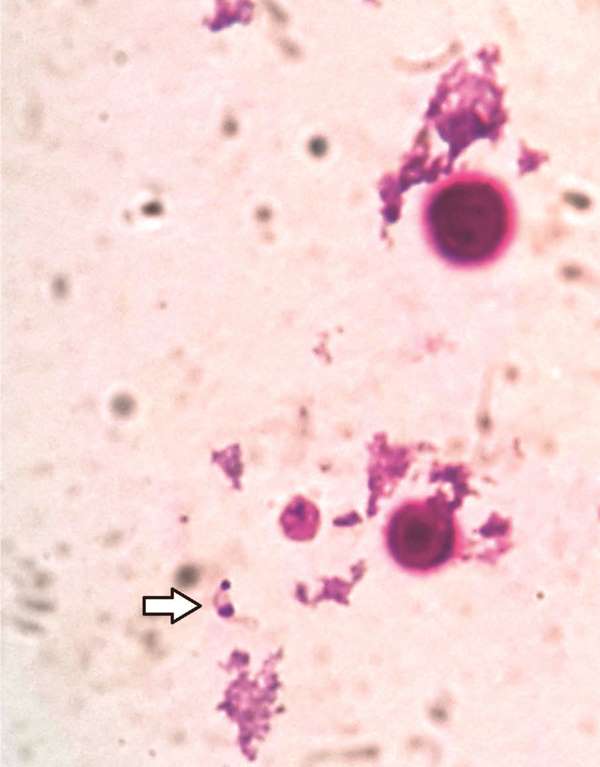 Preparación microscópica coloreada con Giemsa del concentrado del LCR, que revela con objetivo de inmersión (1.000x), dos levaduras y un tripomastigote (señalado con una flecha), ambos en el mismo campo microscópico.
