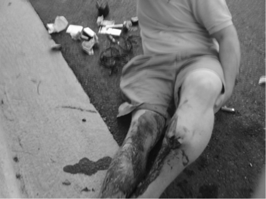 Picture of broken leg