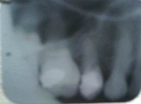 Radiografíadonde se observa gran neumatización del seno maxilar, ausencia de lesión periapical a nivel del 15, solo ligero engrosamiento de espacio desmodontal en dicha zona con reforzamiento de la cortical ósea.