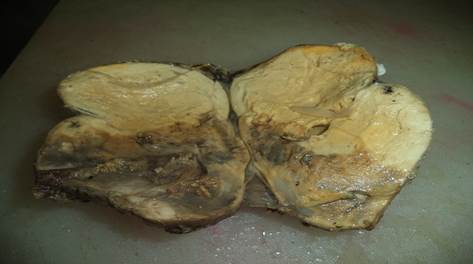 A su corte: tejido sólido aparentemente encapsulado con áreas de necrosis, hemorragia y algunas dilataciones quísticas. 