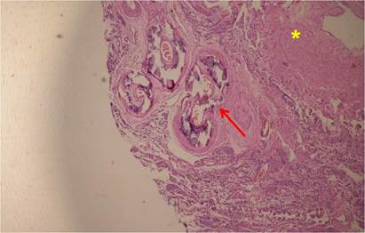 Corte de útero en el que se observa miometrio* y arterias con calcificación de la túnica media (flecha). (Vista de 10X).