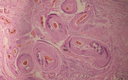 Calcificación de gran número de arterias. (Vista de 20X).