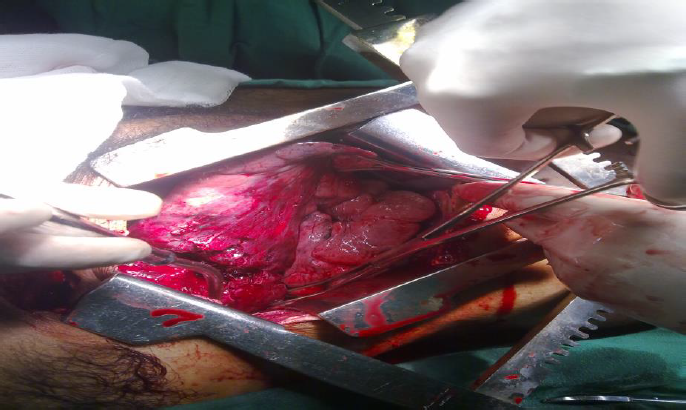 Herida anfractuosa transfixiante del lóbulo superior del pulmón derecho
