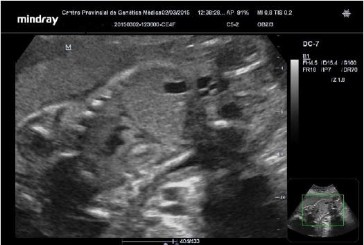 Imágenes hiperecogénicas dentro del ventrículo izquierdo, ventrículo derecho y tabique interventricular.