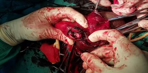 Imagen transoperatoria donde se observa la fractura de los cuerpos cavernosos.