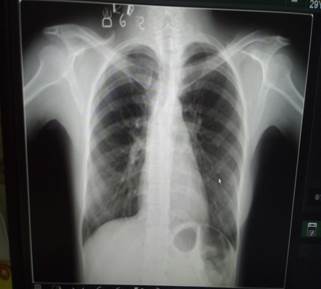 Radiografía digital de tórax vista PA realizada al ingreso.