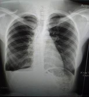 Radiografía digital de tórax vista PA con hidroneomotórax derecho.