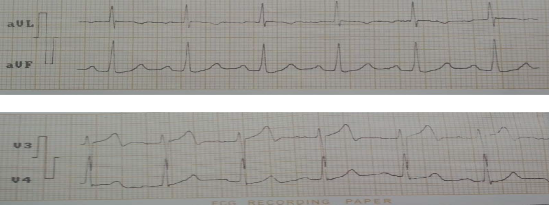 A las 2 horas: QRS normal, T negativa en DI, AVL, VI, V2, T con deflexiones positiva negativa en V3.