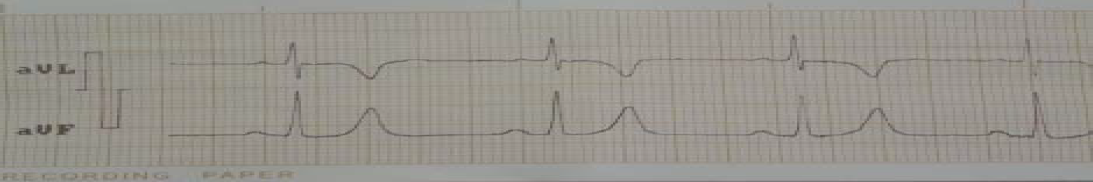 Doce horas después: profundización de las T negativas en las derivaciones del electro anterior.