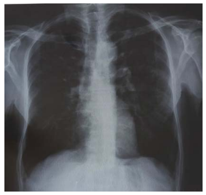 Lesiones sugestivas de proceso inflamatorio intersticial.