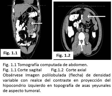Realce hasta 67 UH con aspecto de tumor de asas delgadas