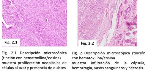 Coloraciónde giensa y tricomica de Masson positivas.