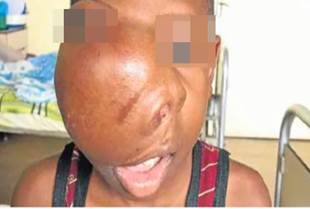 Deformidad facial por displasia fibrosa ósea que desplaza tabique nasal y limitación de la apertura bucal.