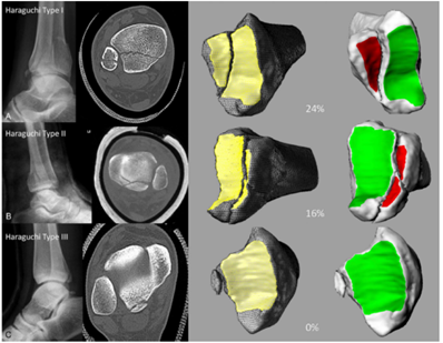 Clasificaci&oacute;n de Haraguchi, et al. 1A. Fractura tipo I. 2B. Fractura tipo II. 2C. Fractura tipo III.