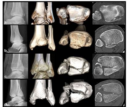 Clasificaci&oacute;n de Barton&iacute;ček, et al. 2a. Fractura tipo 1. 2b. Fractura tipo 2. 2c. Fractura tipo 3. 2d. Fractura tipo 4.