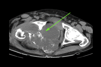 Tomograf&iacute;a axial computarizada (TAC). Obs&eacute;rvese imagen tumoral mixta en hemipelvis derecha que invadi&oacute; y desplaz&oacute; los &oacute;rganos de la cavidad.