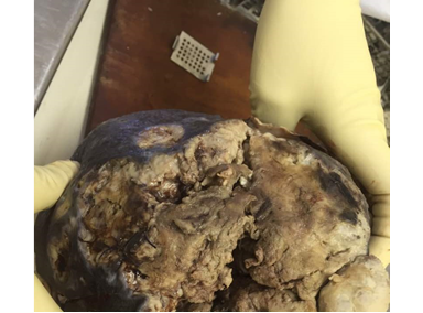 Tumoraci&oacute;n gigante de mama izquierda con necrosis y ulceraci&oacute;n.