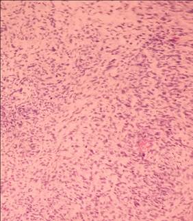 Tejido estromal sarcomatoso.