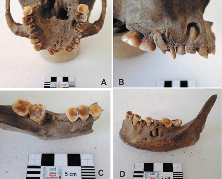 a) Desgaste dental y proceso infeccioso en el M1 derecho, en cara lingual; b) Desgaste dental, dislocación del M1 derecho (flecha izquierda) y proceso infeccioso en el PM1 derecho (flecha derecha); c) Desgaste dental y PDAM del M1 derecho; d) Desgaste dental, proceso infeccioso en M1 izquierdo (flecha derecha) y resto radicular de PM1 izquierdo (flecha izquierda).