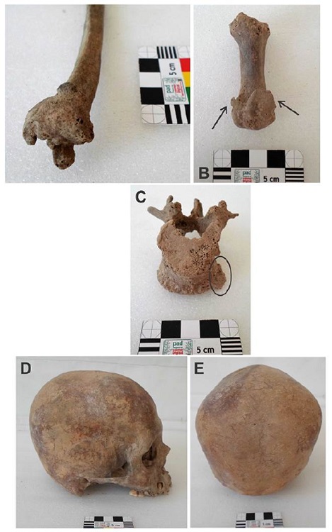 a) Osteofitosis en la epífisis distal del cúbito derecho; b) Extensión de la carilla articular de la epífisis distal del primer metatarso derecho; c) Vértebra lumbar con alteraciones tafonómicas y osteofitosis (círculo negro); d) Deformación craneana de tipo tabular erecto en norma lateral y occipital (e)