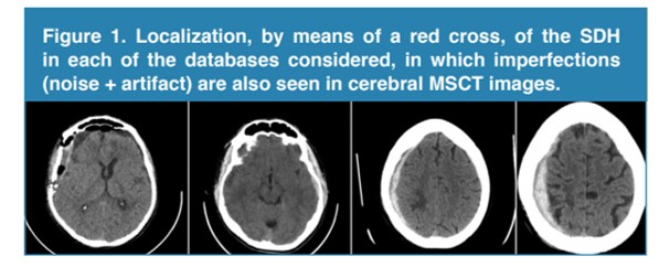 Localization, by means of a red cross, of the SDH in each of the databases considered, in which imperfections (noise + artifact) are also seen in cerebral MSCT images