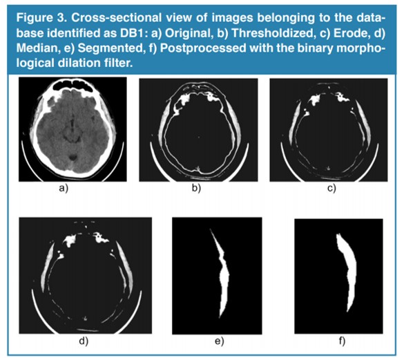 Cross-sectional view of images belonging to the database identified as DB1: a) Original, b) Thresholdized, c) Erode, d) Median, e) Segmented, f) Postprocessed with the binary morphological dilation filter.