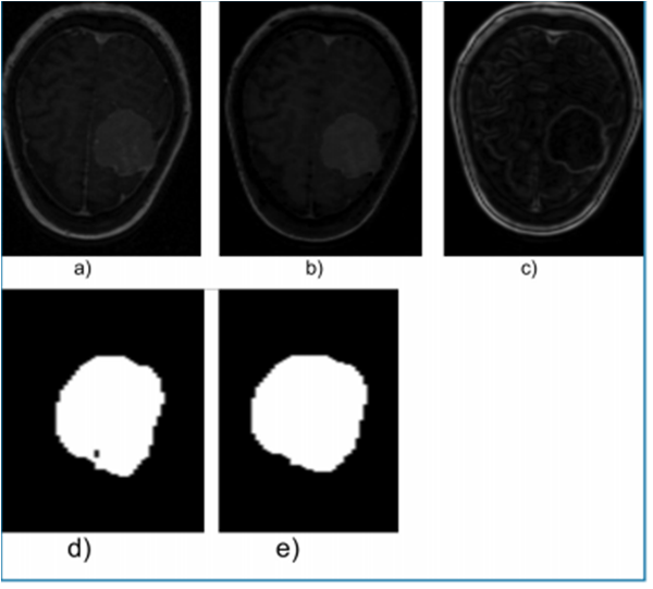 Axial view of images belonging to DB1: a) Original, b) Erode, c) Gradient magnitude, d) Segmented with region growing technique, e) MGT Dilated.