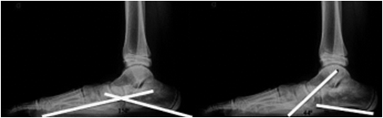 Mediciones Radiológicas realizadas pre y operatoriamente para la evaluación de pie plano.