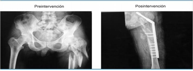 Paciente de 43 a&ntilde;os con fractura subtrocant&eacute;rica de f&eacute;mur derecho GIIIB. Osteos&iacute;ntesis con placa DHS de 12 orificios m&aacute;s aloinjerto de chip de esponjosa de 60 cc.