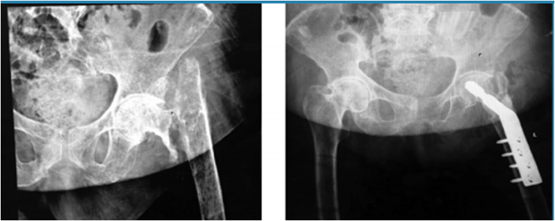 Paciente de 67 a&ntilde;os de edad con fractura de cuello de f&eacute;mur izquierdo de 4 meses de evoluci&oacute;n, se realiz&oacute; osteos&iacute;ntesis con placa DHS de 4 orificios con aporte de aloinjerto de chip de esponjosa 30 cc.