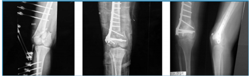 Paciente de 22 a&ntilde;os con fractura de f&eacute;mur distal GII. Inicialmente se utiliz&oacute; fijador externo, se esper&oacute; mejor&iacute;a de partes blandas luego se realiz&oacute; osteos&iacute;ntesis con placa condilar bloqueada m&aacute;s 30 cc de aloinjerto &oacute;seo.