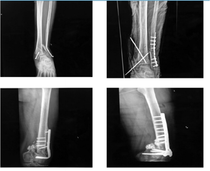 Paciente de 52 a&ntilde;os con fatiga de material de osteos&iacute;ntesis. Se retir&oacute; el material quir&uacute;rgico, y se realiz&oacute; osteos&iacute;ntesis con placa tercio de ca&ntilde;a y fijaci&oacute;n percut&aacute;nea con clavos de Steinman m&aacute;s aporte de aloinjerto &oacute;seo 30 cc.