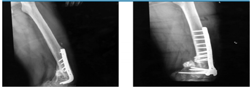 Paciente de 27 a&ntilde;os de edad con diagn&oacute;stico de pseudoartrosis de f&eacute;mur distal m&aacute;s fatiga de material de osteos&iacute;ntesis de 4 a&ntilde;os de evoluci&oacute;n. Se retir&oacute; material, se realiz&oacute; osteos&iacute;ntesis con placa condilar bloqueada de 9 orificios m&aacute;s aporte de aloinjerto &oacute;seo 60 cc.