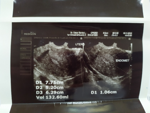 Ecograf&iacute;a transvaginal: &uacute;tero en anteversi&oacute;n de 7,7 x 5,2 x 6,2 cm de di&aacute;metro con un volumen estimado de 132 cc.
