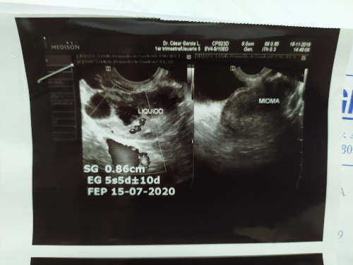 Ecograf&iacute;a transvaginal: im&aacute;genes sugestivas de embarazo ect&oacute;pico accidentado de ovario derecho, edad gestacional 5,5 semanas m&aacute;s/menos 10 d&iacute;as.