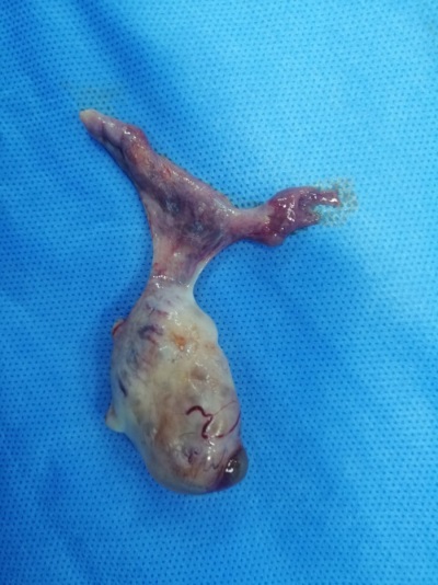 Ovario derecho con saco amni&oacute;tico