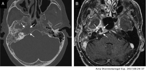 Tomografía computarizada de cráneo con imagen compatible con mastoiditis y absceso de oído medio derecho.