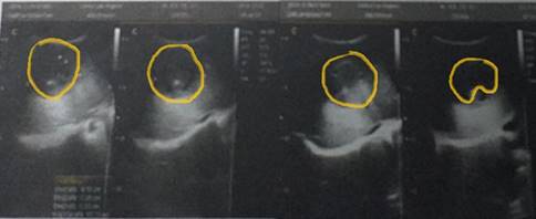 Abdominal ultrasound A mixedecho rounded spaceoccupying lesion is observed in the anterosuperior portion of the liver with a tendency to homogeneity