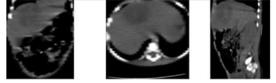 Abdominal CT. The liver lesion on CT does not have the appearance of a peripheral pseudo-capsule showing rim enhancement, rather it is in the form of a solid liver mass.