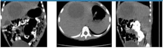 Contrast-enhanced CT of abdomen. The pathological features of an amebic liver abscess that include an outstanding chronic inflammatory response circumscribed around a stringy rim with a very small center necrotic and suppurative, were not verified in the contrast-enhanced CT.