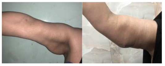 Preoperative and postoperative photograph of patient with standard brachioplasty. Note, residual skin redundancy that required revision.