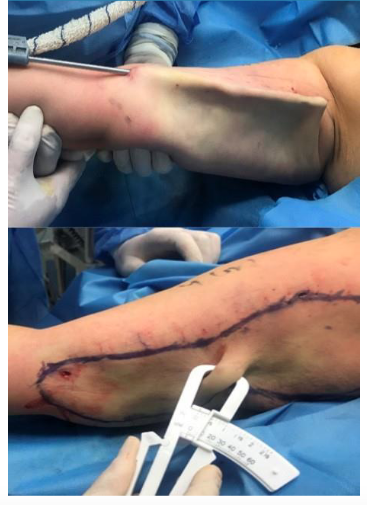 Left liposuction until no fat. Right, skin fat clipper indicate zero fat after liposuction