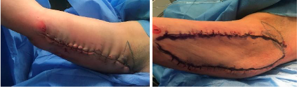Left placement of the staples and assessment of the tension. Right: removal of the staples and drawing the final mark for excision.