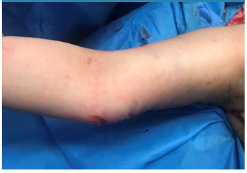 intraoperative view after resection